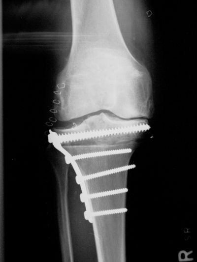 Synthes L. Plate (Implant 163)